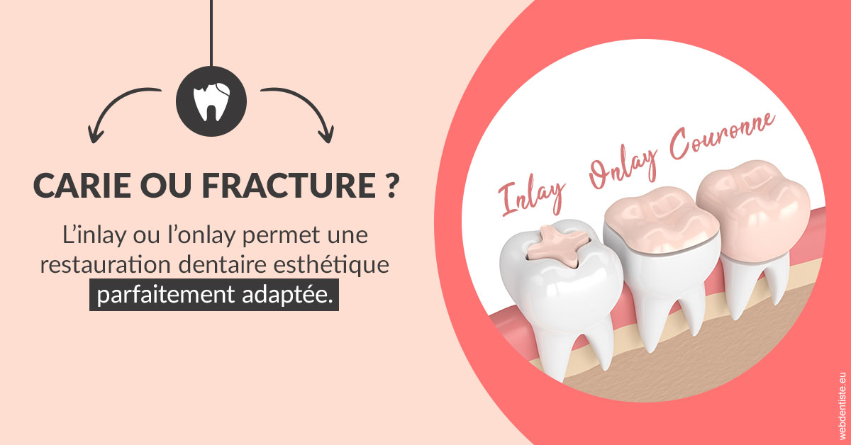 https://dr-loic-calvo.chirurgiens-dentistes.fr/T2 2023 - Carie ou fracture 2