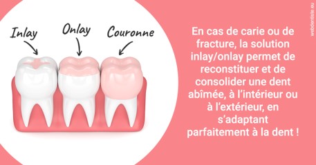 https://dr-loic-calvo.chirurgiens-dentistes.fr/L'INLAY ou l'ONLAY 2