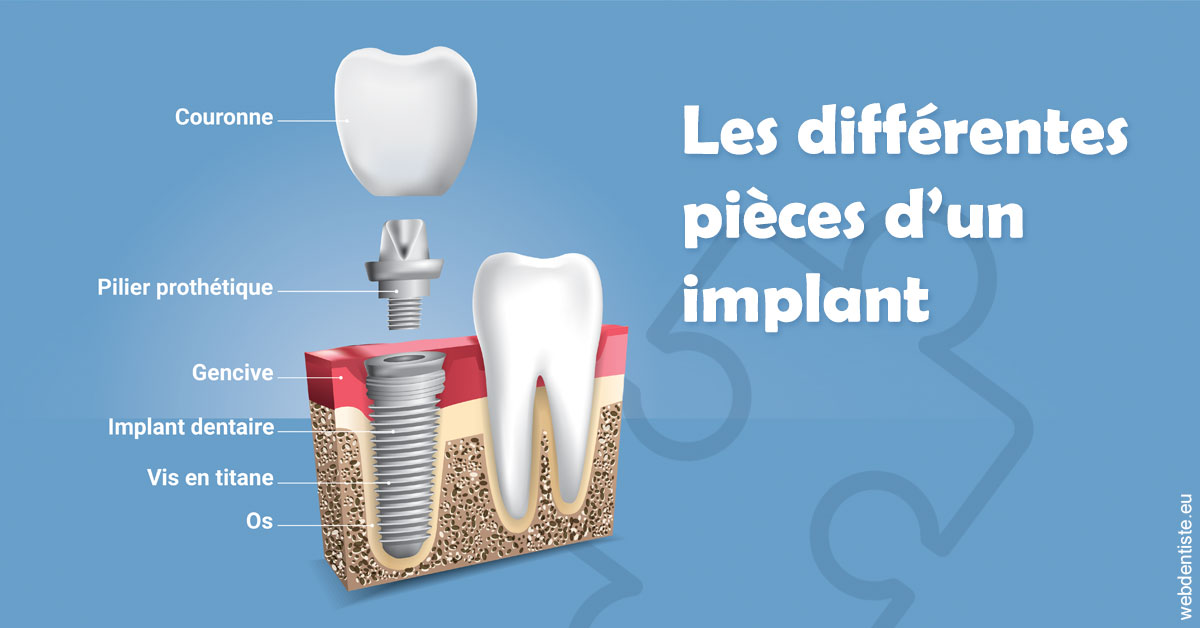 https://dr-loic-calvo.chirurgiens-dentistes.fr/Les différentes pièces d’un implant 1